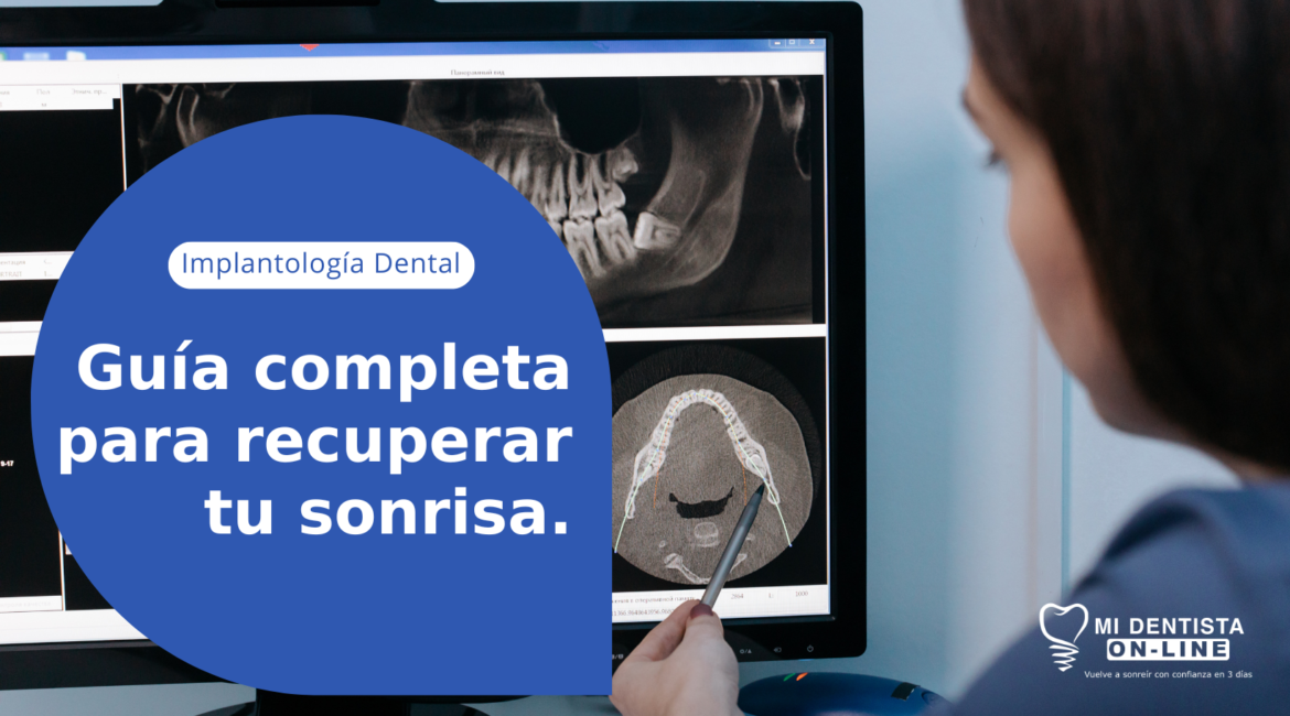 Guia para recuperar tu sonrisa. Implantes Dentales