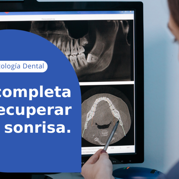 Guia para recuperar tu sonrisa. Implantes Dentales