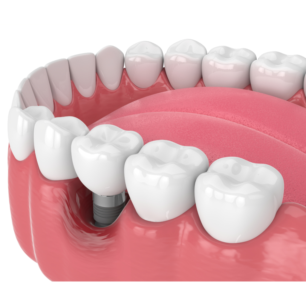 Implantes dentales en rapidos cdmx