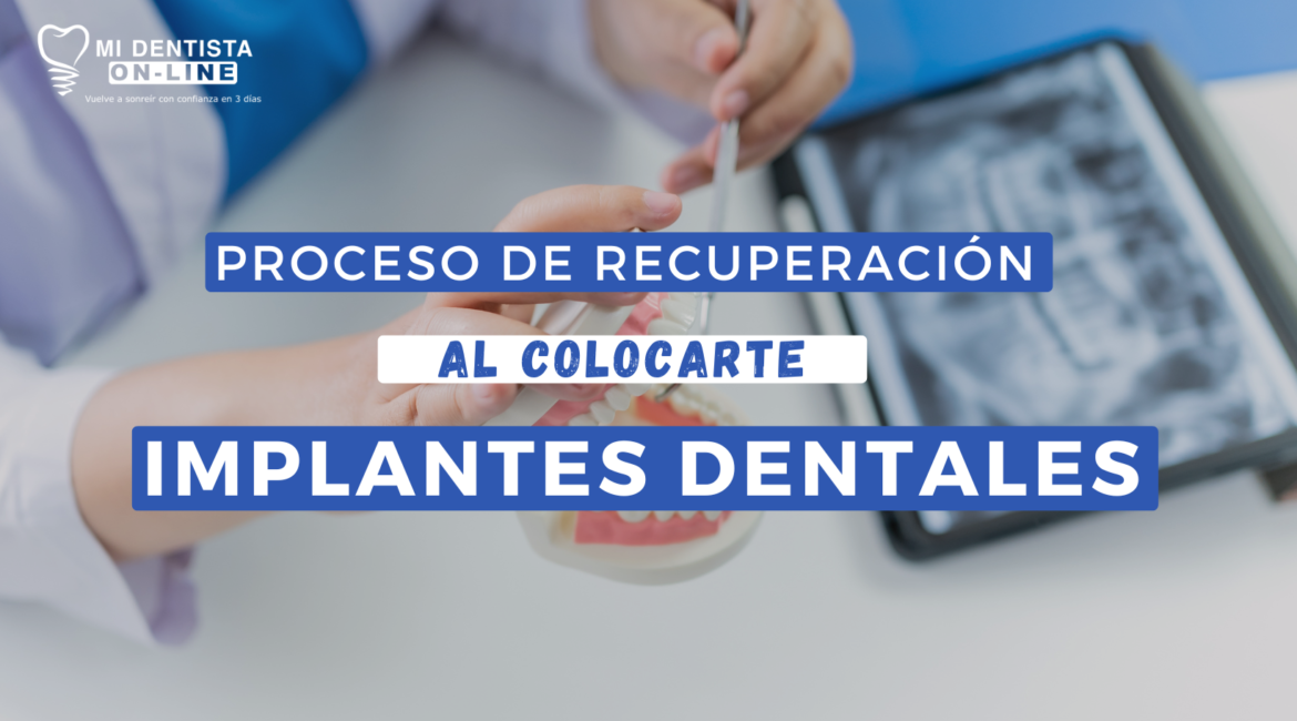 Cuidados post operatorios al colocarte implantes dentales