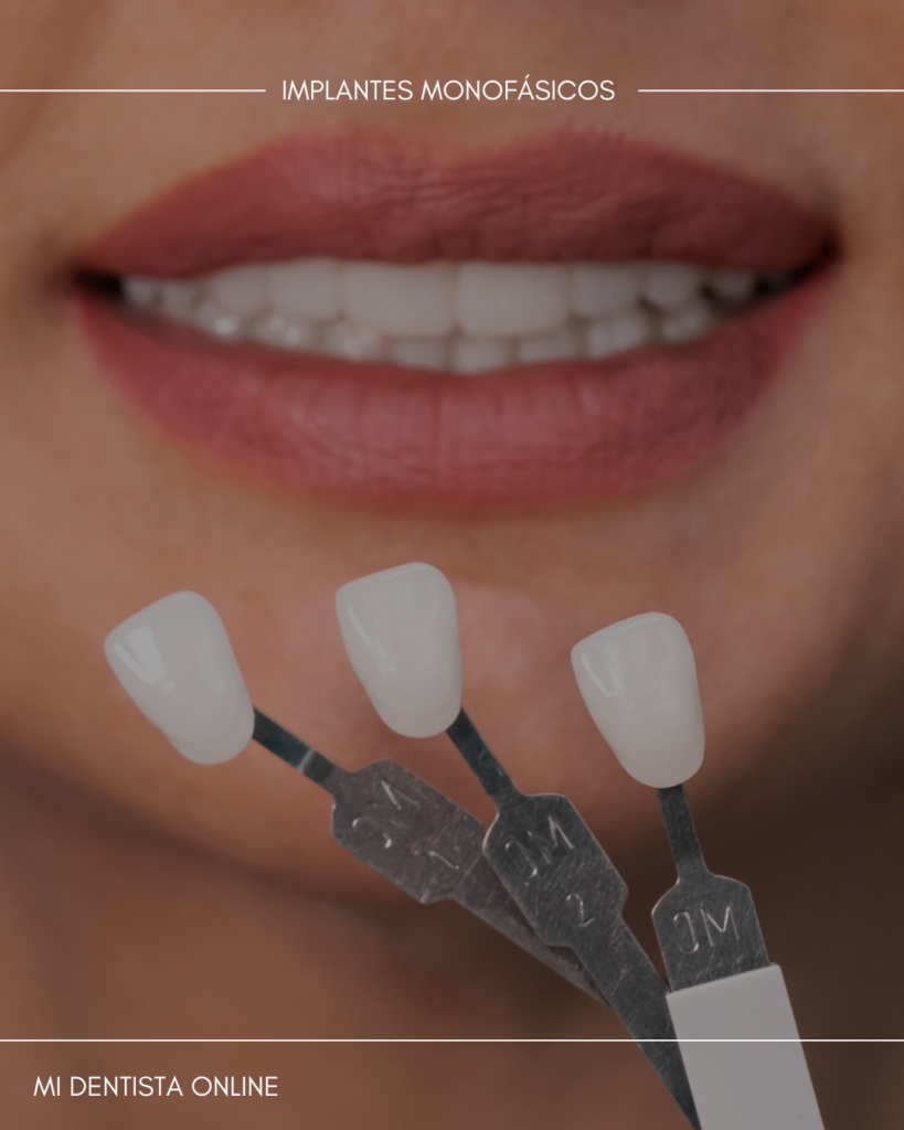 Implantes dentales monofásicos cdmx