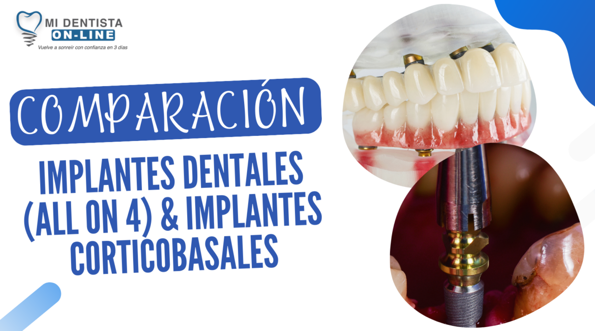 diferencia entre Implantes all on 4 y corticobasales