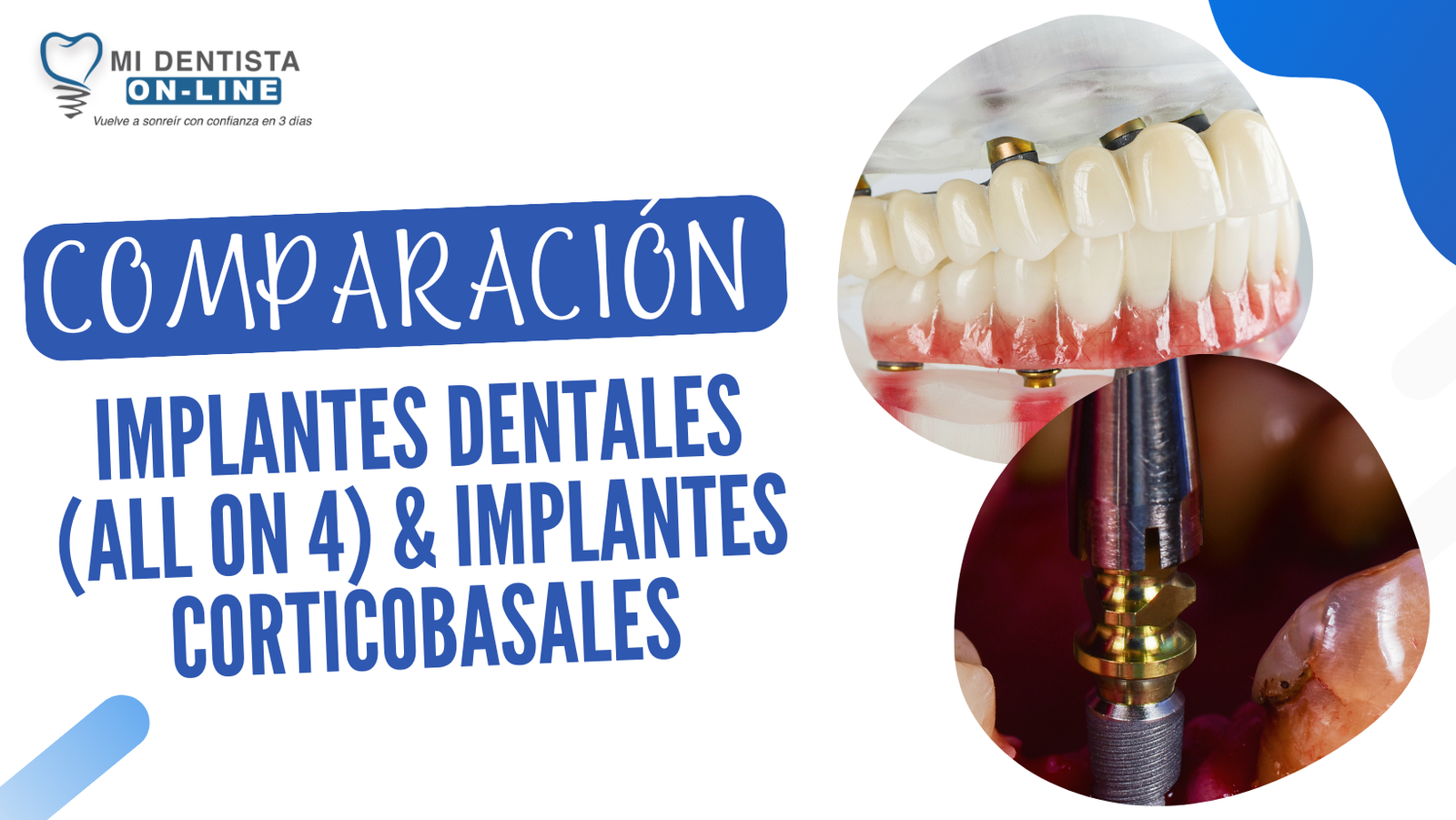 Implantes Dentales LARGA Lanza Piloto | Pack De 4 Unidades | Acero Inoxidable CE