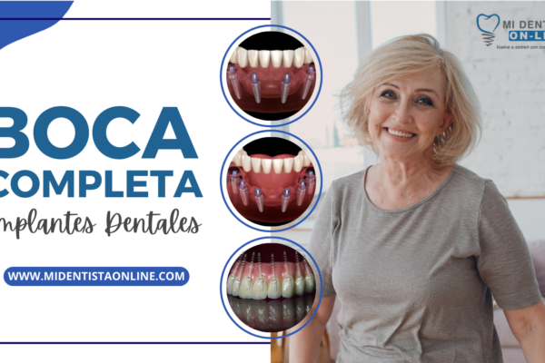 Implantes dentales para boca completa