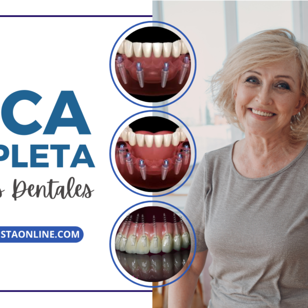 Implantes dentales para boca completa