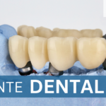 ¿Qué es un puente dental?