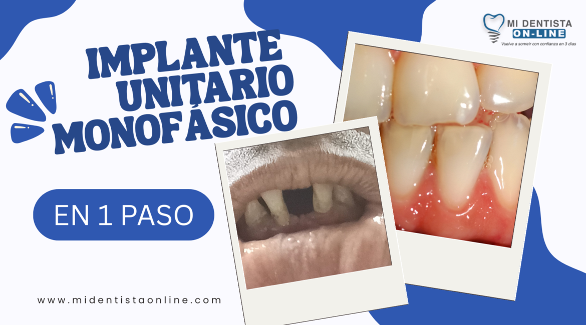 implante dental unitario en un solo paso