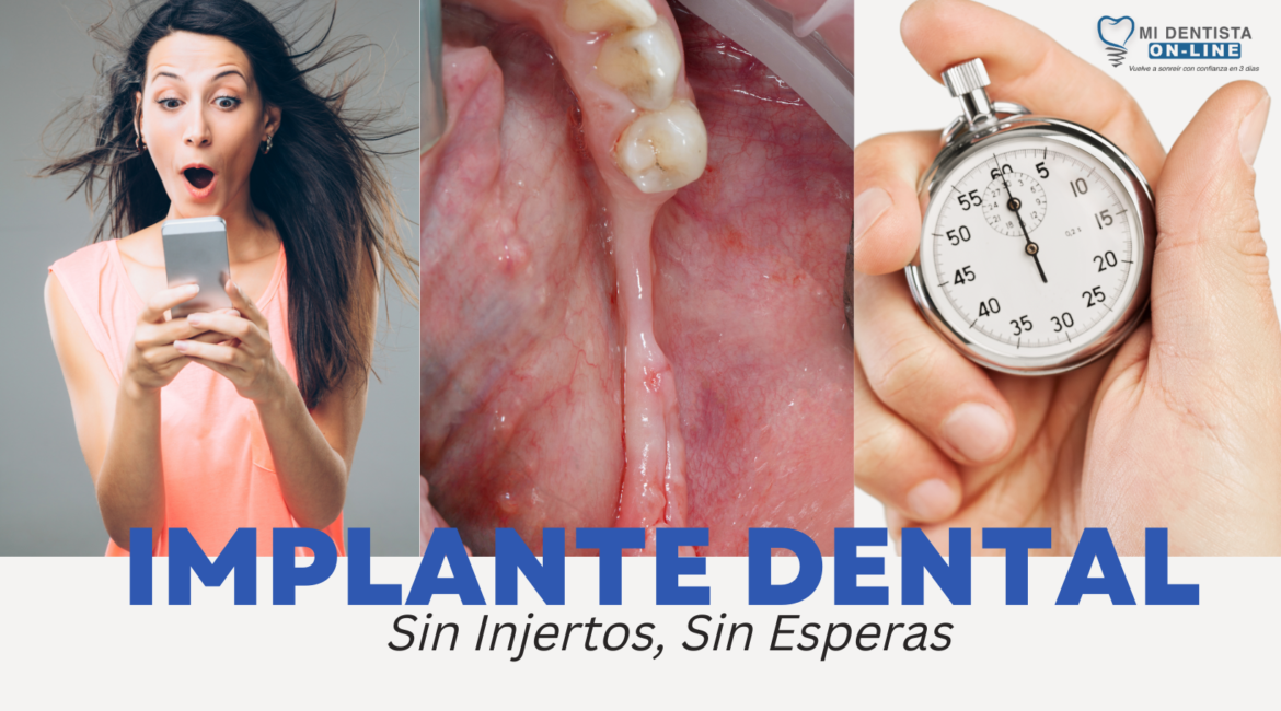 Implante dental sin injeto, si esperas