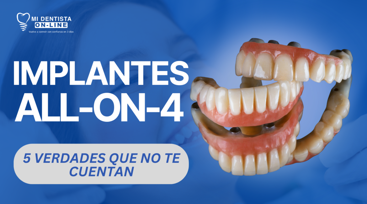 Implantes all-on-4