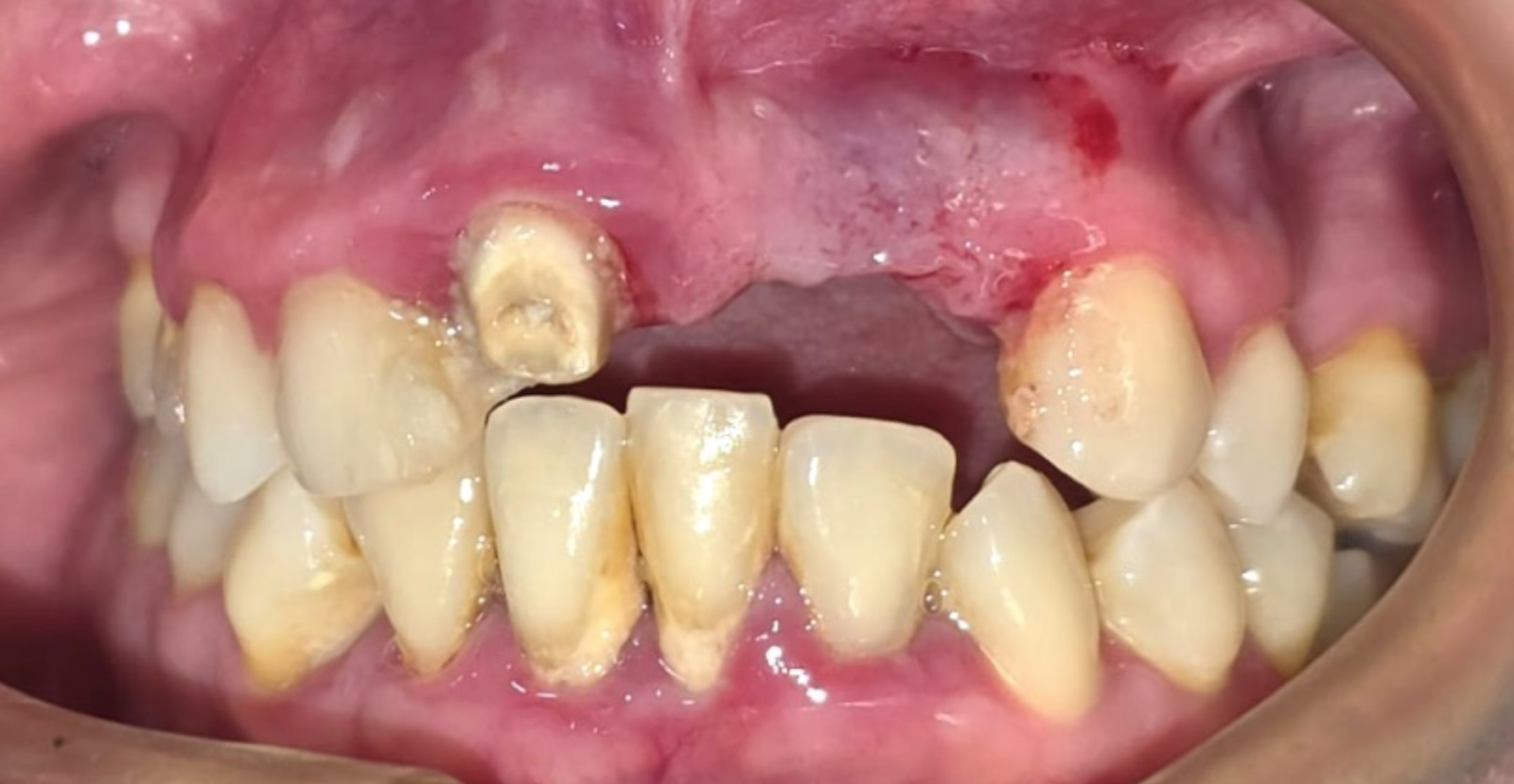 dentadura postiza fija antes
