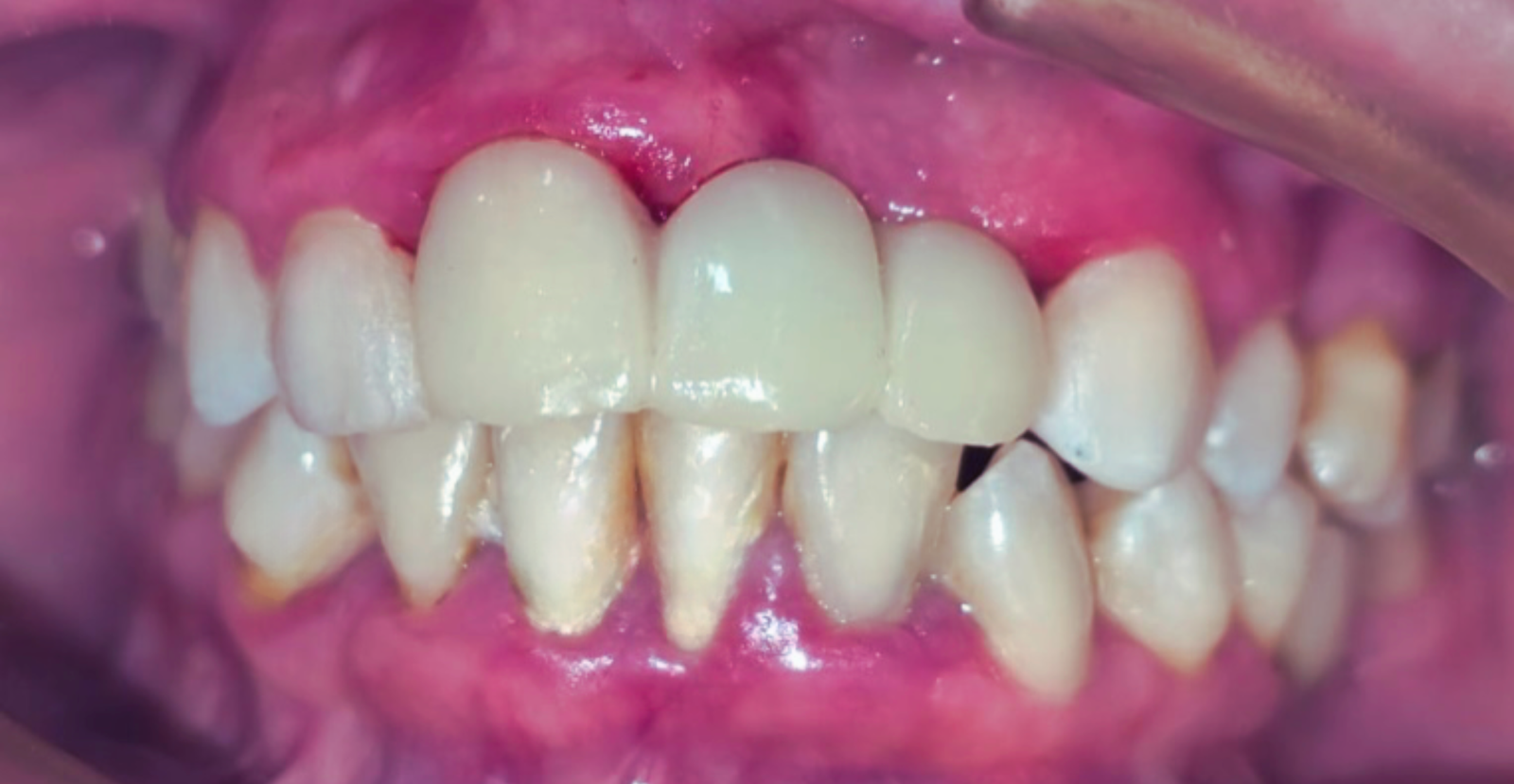 dentadura postiza fija con implantes monofásicos el mismo día