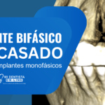 Implante Fracasado: Solución en CDMX con Implantes Monofásicos