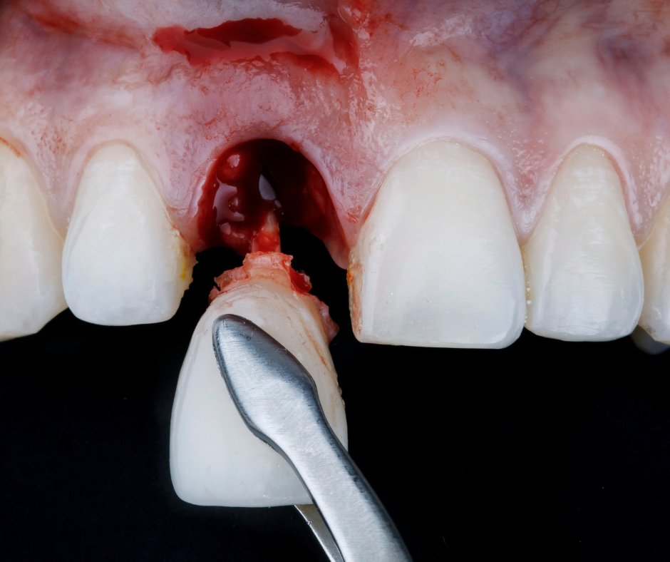 sin molestias implantes dentales cdmx