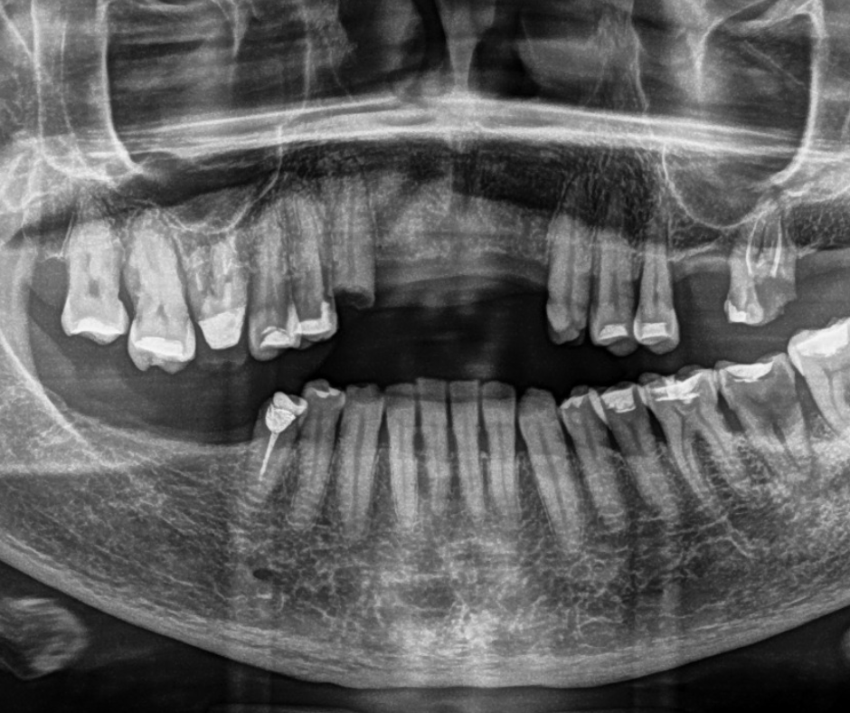Radiografía colocación implantes dentales