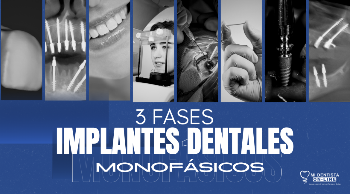 3 fases para colocación de implantes dentales monofásicos