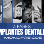 3 Fases de tu tratamiento de Implantes Dentales monofásicos en Ciudad de México