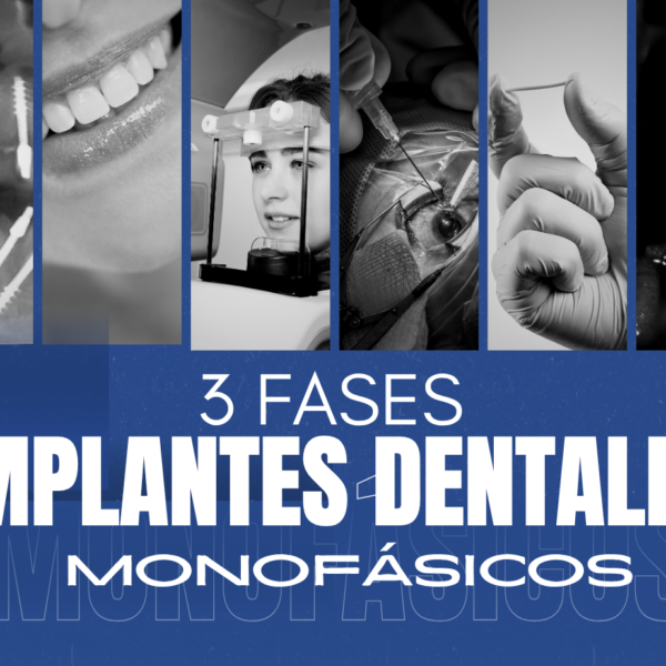 3 fases para colocación de implantes dentales monofásicos