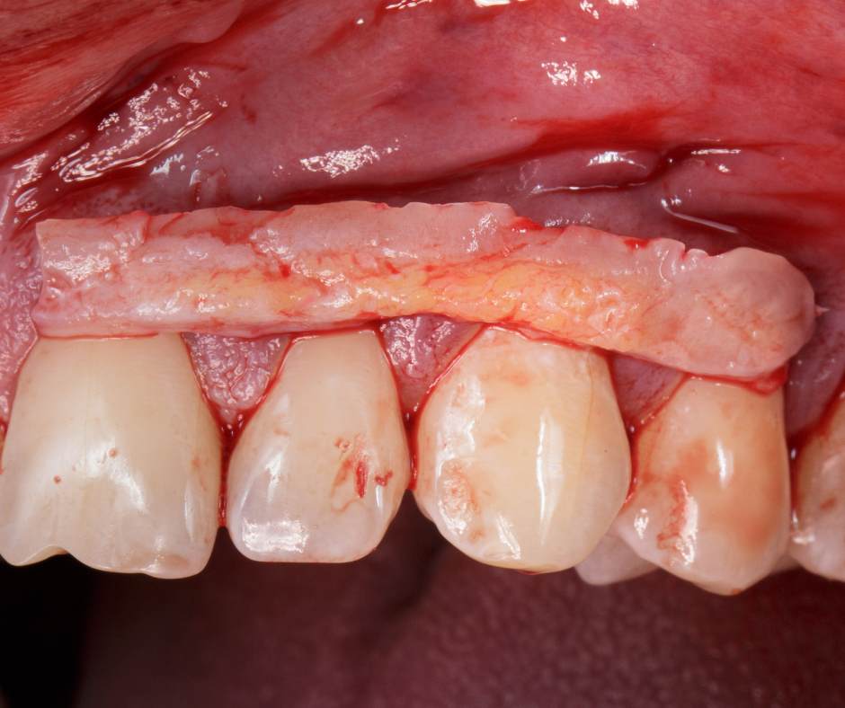 cirugia sin complicaciones implantes dentales