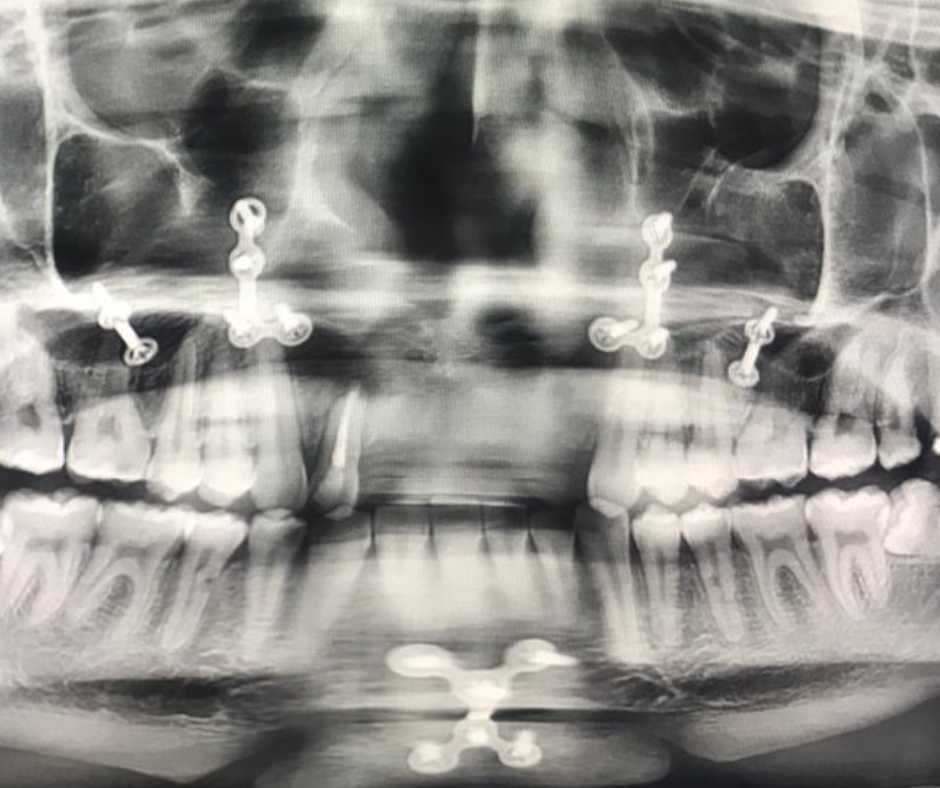 Radiografia colocación implantes dentales en cdmx precio