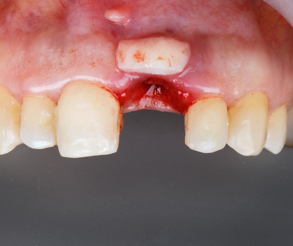 sin injerto de hueso implante dental cdmx