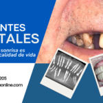 Implantes Dentales Monofásicos: Caso de Éxito en  Paciente